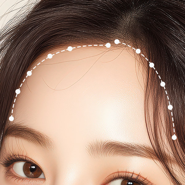 헤어라인 더모톡신